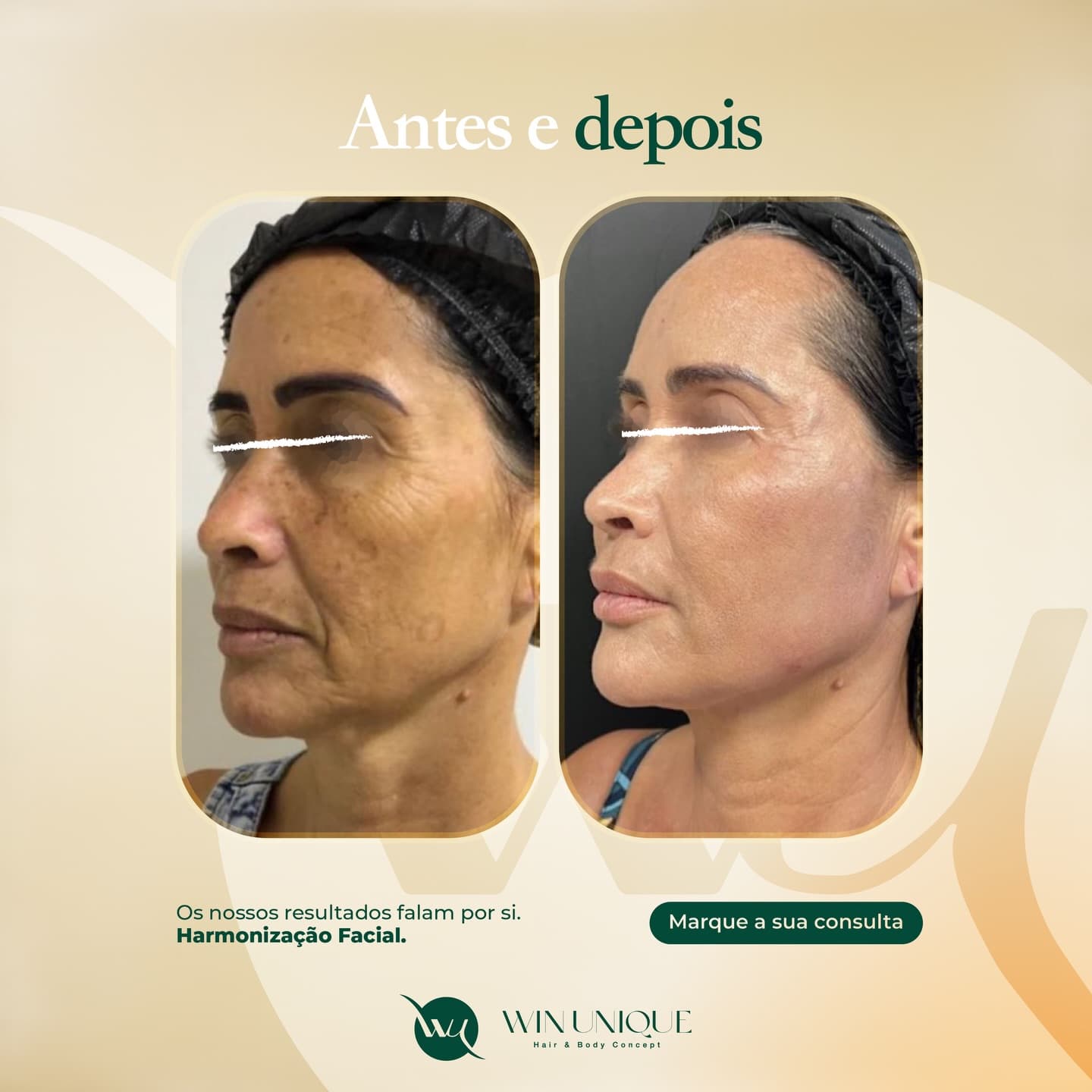 Antes e depois de harmonização facial na Win Unique Clinic, Lisboa.