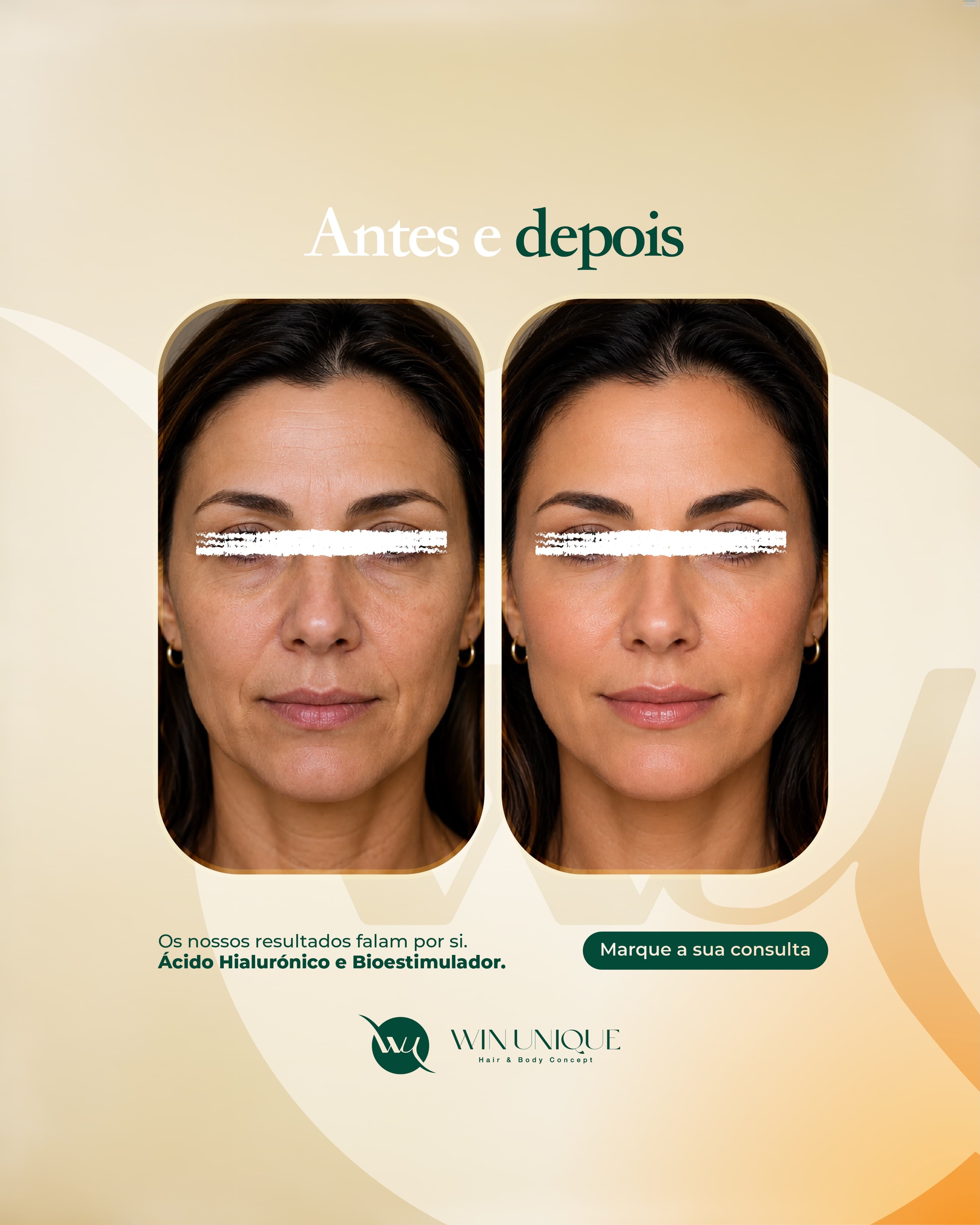 Antes e depois de ácido hialurónico e bioestimulador de colagénio na Win Unique Clinic, Lisboa.
